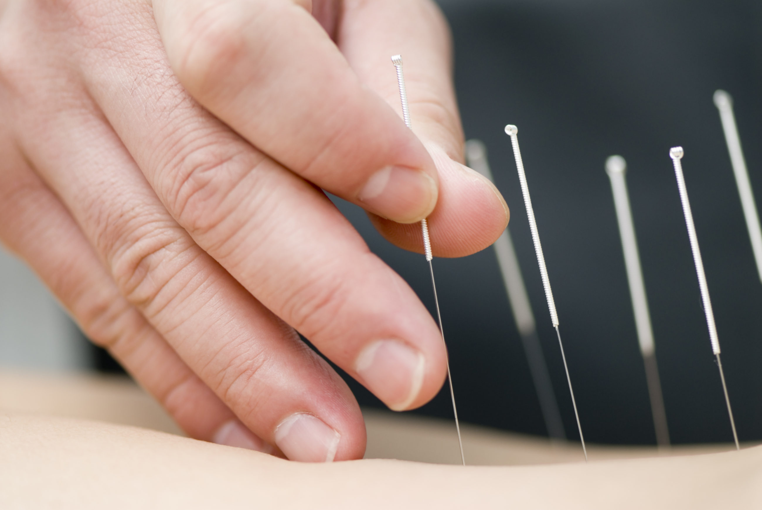 Dry Needling ATLANTA SPORT AND SPINE PHYSICAL THERAPY